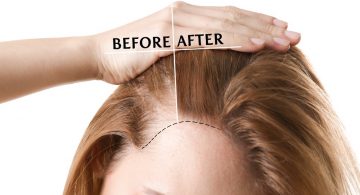Luttez contre la chute de cheveux avec le traitement PRP