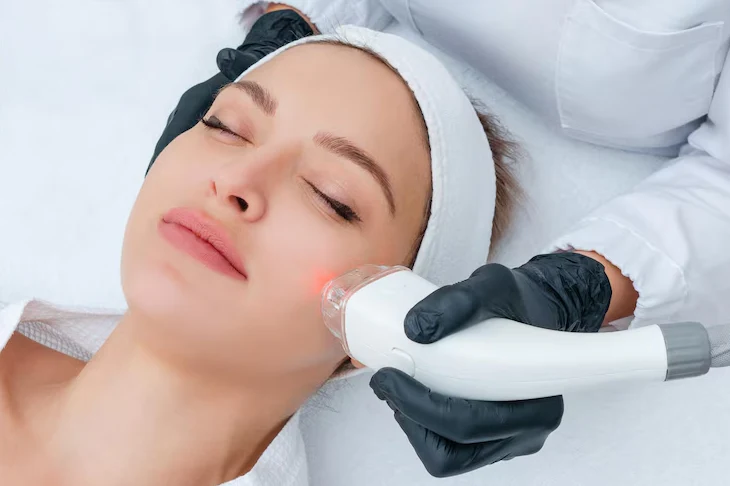 Radiofréquence pour le visage : raffermir la peau sans chirurgie