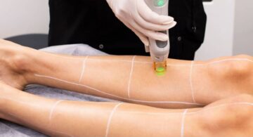 Épilation Laser à Bruxelles : Prix, Résultats et Avantages du Traitement