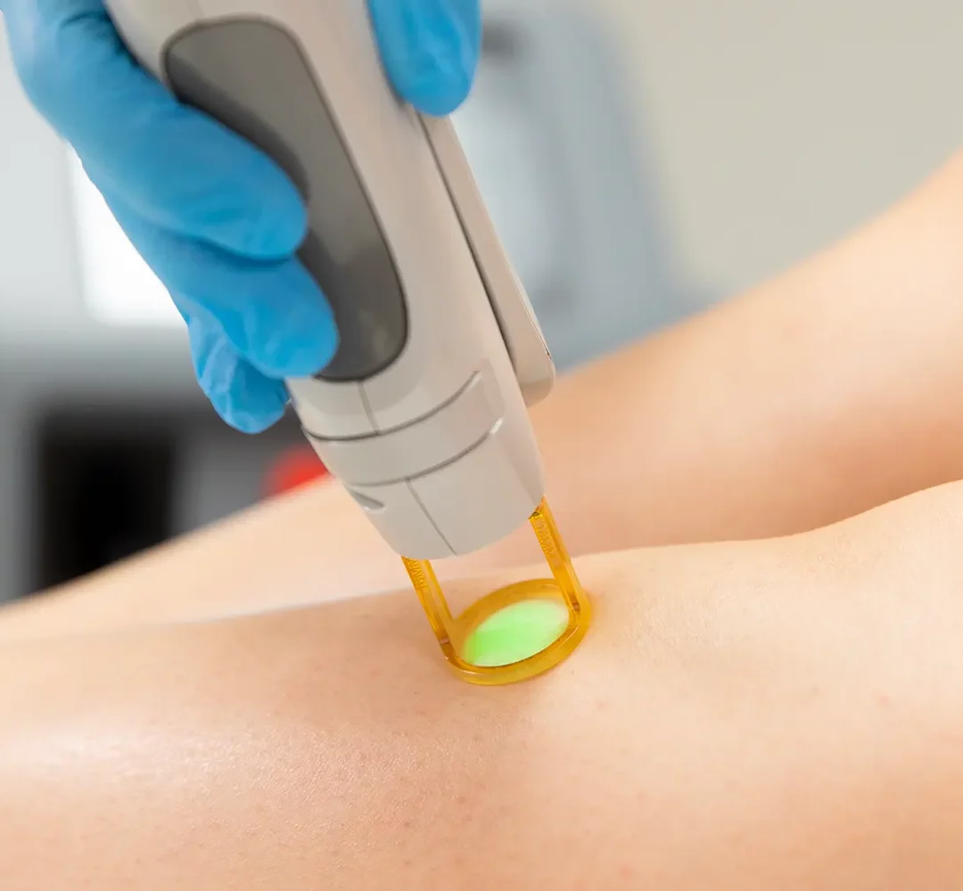 Épilation au Laser à Bruxelles : Guide Complet pour une Peau Douce et Sans Poils