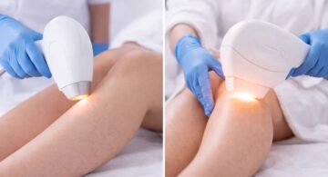 Épilation par lumière pulsée : méthode moderne pour peau douce et durable