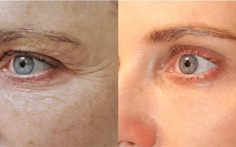 Découvrez le Laser CO2 visage Bruxelles, sa préparation et sa récupération. Suivez nos conseils pour bien préparer votre séance. Découvrez le Laser CO2 visage Bruxelles, sa préparation et sa récupération. Suivez nos conseils pour bien préparer votre séance.