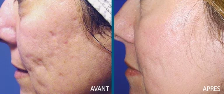 La Radiofréquence fractionnée visage améliore la texture de la peau, réduit les rides et atténue les cicatrices pour une peau plus lisse.
